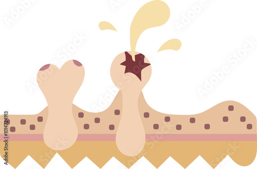 Skin tissue infection illustration