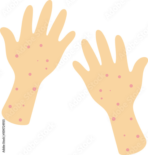 Hand rashes illustration