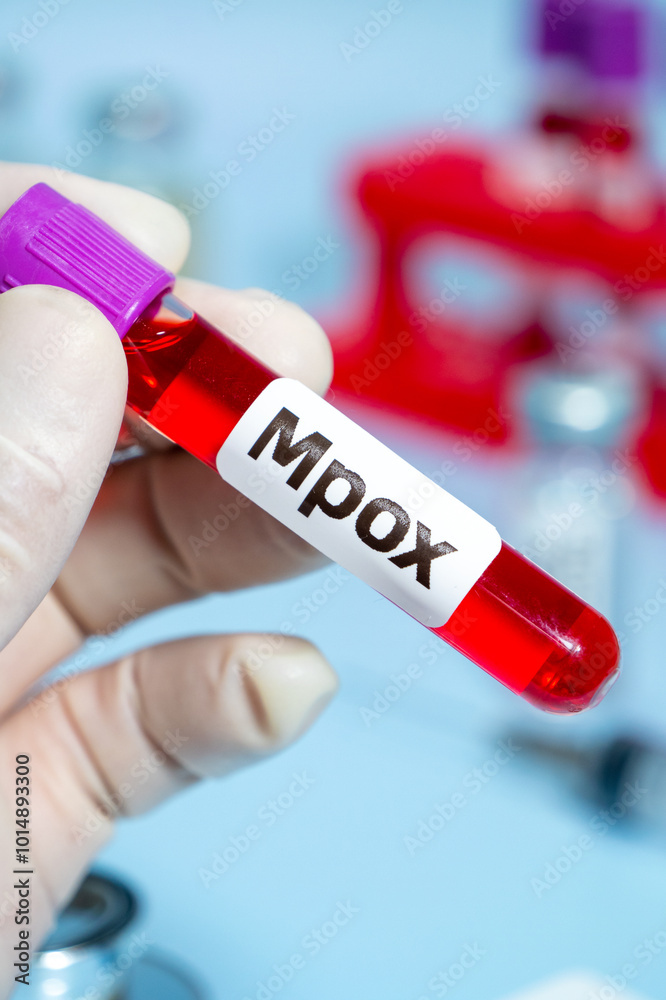 Obraz premium Blood collection tubes Mpox test positive results,WHO to rename monkeypox as ‘Mpox’
