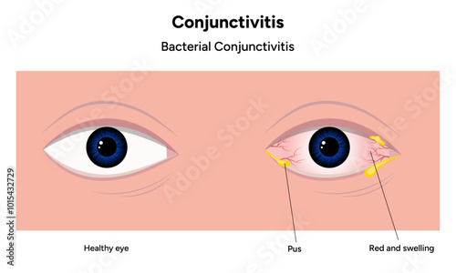 Bacterial conjunctivitis. Ophthalmology diseases conjunctiva 
