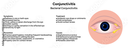 Bacterial conjunctivitis. Ophthalmology diseases conjunctiva symptoms, causes, treatment, prevention 