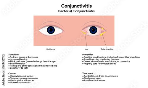 Bacterial conjunctivitis. Ophthalmology diseases conjunctiva symptoms, causes, treatment, prevention 