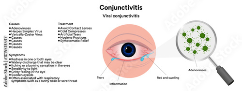 Viral conjunctivitis. Ophthalmology diseases conjunctiva. Causes, symptoms and treatment infographic 