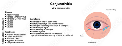 Viral conjunctivitis. Ophthalmology diseases conjunctiva. Causes, symptoms and treatment infographic 