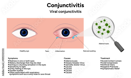 Viral conjunctivitis. Ophthalmology diseases conjunctiva. Causes, symptoms and treatment infographic 