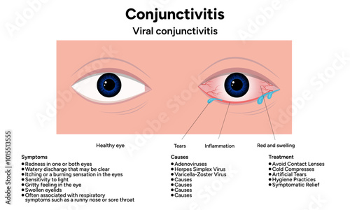 Viral conjunctivitis. Ophthalmology diseases conjunctiva. Causes, symptoms and treatment infographic 