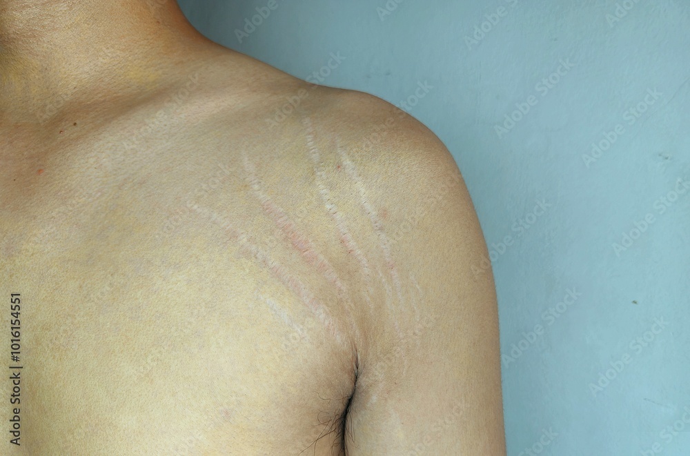 Fototapeta premium stretch marks on armpit skin area