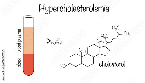 Hypercholesterolemia