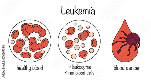 Leukemia
