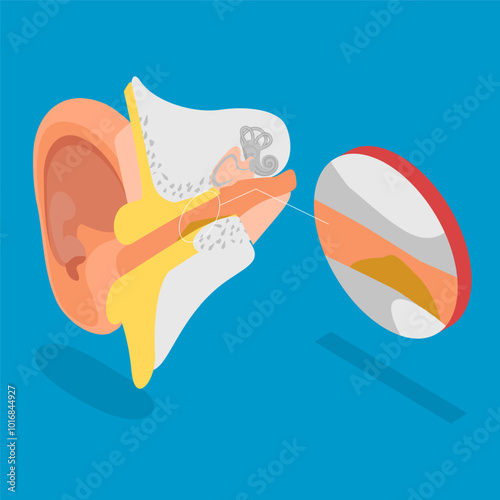 3D Isometric Flat Vector Illustration of Earwax Blockage, Blocked Ear Canal Due To Excess Ear Wax Buildup