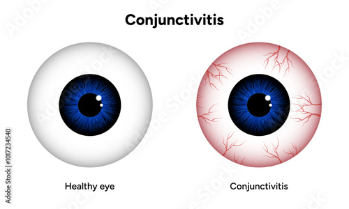 Viral and bacterial conjunctivitis. Ophthalmology diseases