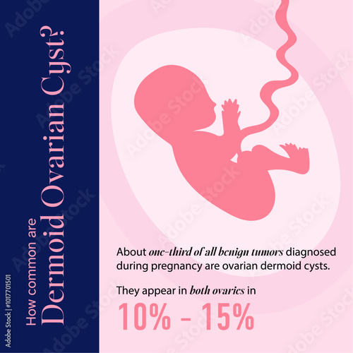 female reproductive system dermoid ovarian cyst percentage illustration