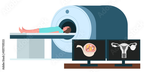 female reproductive system ovarian cyst mri scan illustration