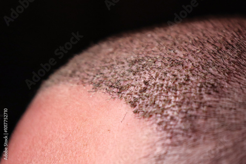 close-up of a head of a man with a recent hair implant on a black background
 photo