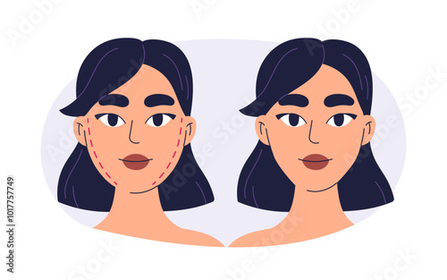 Plastic surgery face transformation. Before, after cosmetic facial lifting, cheek and jawline contouring. Aesthetic makeover, improvement. Flat graphic vector illustration isolated on white background