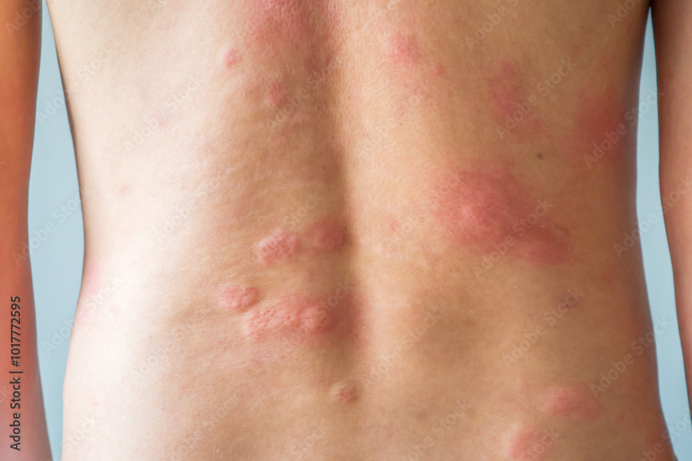 Young asian man itching and scratching on his back from allergic itchy dry skin eczema dermatitis insect bites Young asian man itching and scratching on his back from allergic itchy dry skin eczema dermatitis insect bites