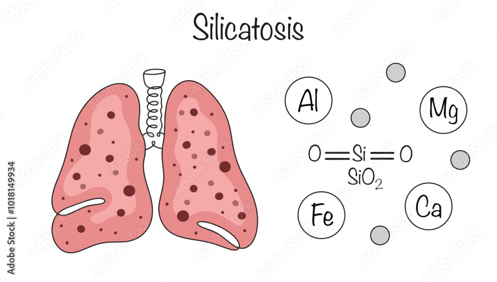 Silicatosis Silicatosis