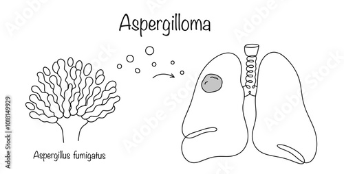Aspergilloma
