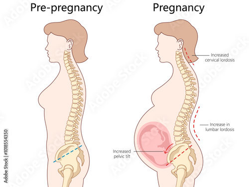 changes in spine alignment from pre-pregnancy to pregnancy, cervical lordosis, lumbar lordosis, pelvic tilt diagram hand drawn schematic vector illustration. Medical science educational illustration