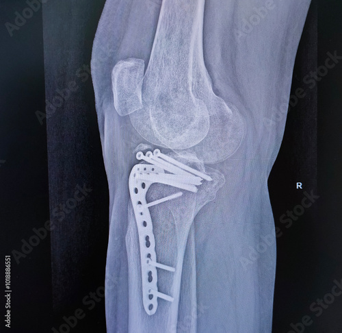 Structure of knee and rx-ray image of knee, tibia fracture with post operation internal fixation.