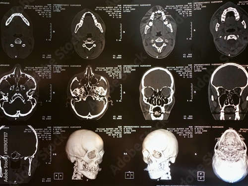 Quadro su tela MRI of the human brain of a patient with multiple sclerosis of the initial stage