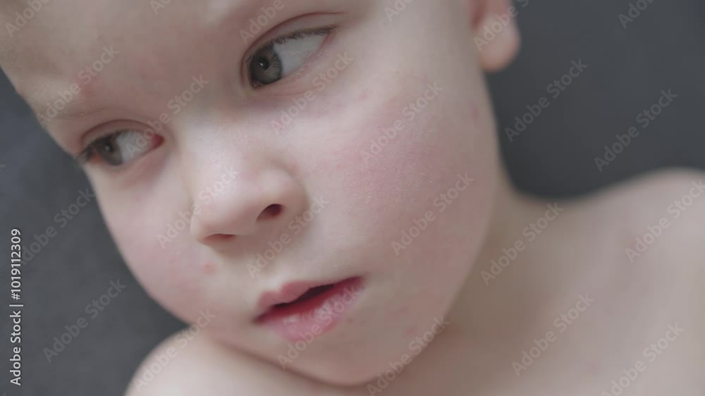 Child with battling chickenpox close-up red spots on sad face. Sad face with red spots of illness boy Valiant effort to remain cheerful eyes betray deep sorrow discomfort Sad face of boy Child with battling chickenpox close-up red spots on sad face. Sad face with red spots of illness boy Valiant effort to remain cheerful eyes betray deep sorrow discomfort Sad face of boy