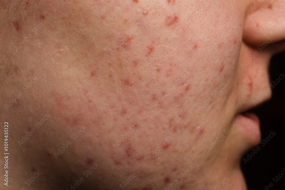 Close-up of the skin with pimple problems. Pimples, acne, pores, scars. Natural skin. Skin texture background. Closeup acne pimple. Treatment for skin. Problem skincare. Skincare concept. Close-up of the skin with pimple problems. Pimples, acne, pores, scars. Natural skin. Skin texture background. Closeup acne pimple. Treatment for skin. Problem skincare. Skincare concept.