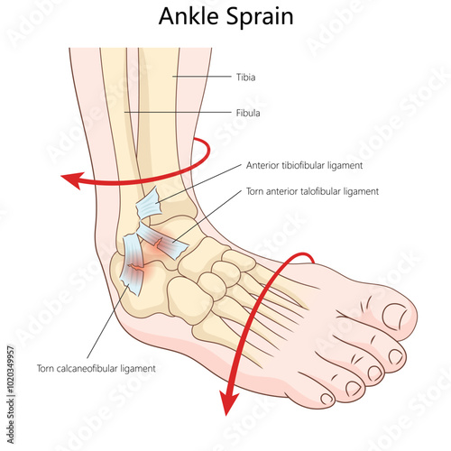 ankle sprain showing torn ligaments, anterior talofibular and calcaneofibular ligaments, injury mechanics diagram hand drawn schematic vector illustration. Medical science educational illustration
