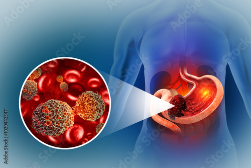 Stomach cancer. Cancer attacking cell. Stomach disease concept. 3d illustration