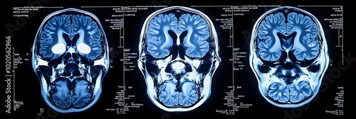 Detailed MRI Scan Reveals the Intricate Anatomy of the Human Brain,Showcasing the Cerebrum,Cerebellum,Cortex,and Other Crucial Neurological Structures and Functions.