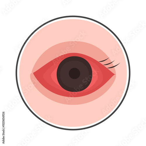 conjunctivitis eyes allergy infection disease