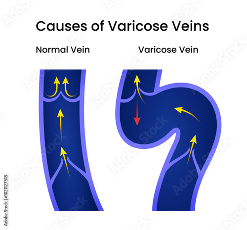 Causes of the Varicose Veins