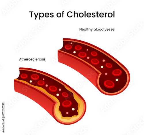 Healthy Blood Vessels and Atherosclerosis