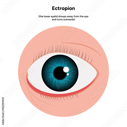 Ectropion eye ophthalmology problem infographic 