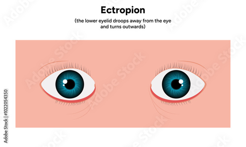 Ectropion eye ophthalmology problem infographic 