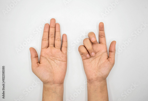 Ulnar claw hand of Asian young woman. Hand deformity. photo
