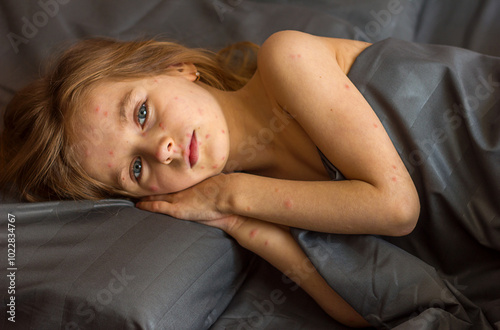 Obraz na plátně Little sad girl with a rash on her face close-up portrait, chickenpox and measle