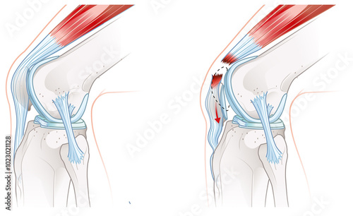 Quadriceps tendon rupture. Knee injury. Sports injury. Knee pain. Front view. Labeled medically illustration