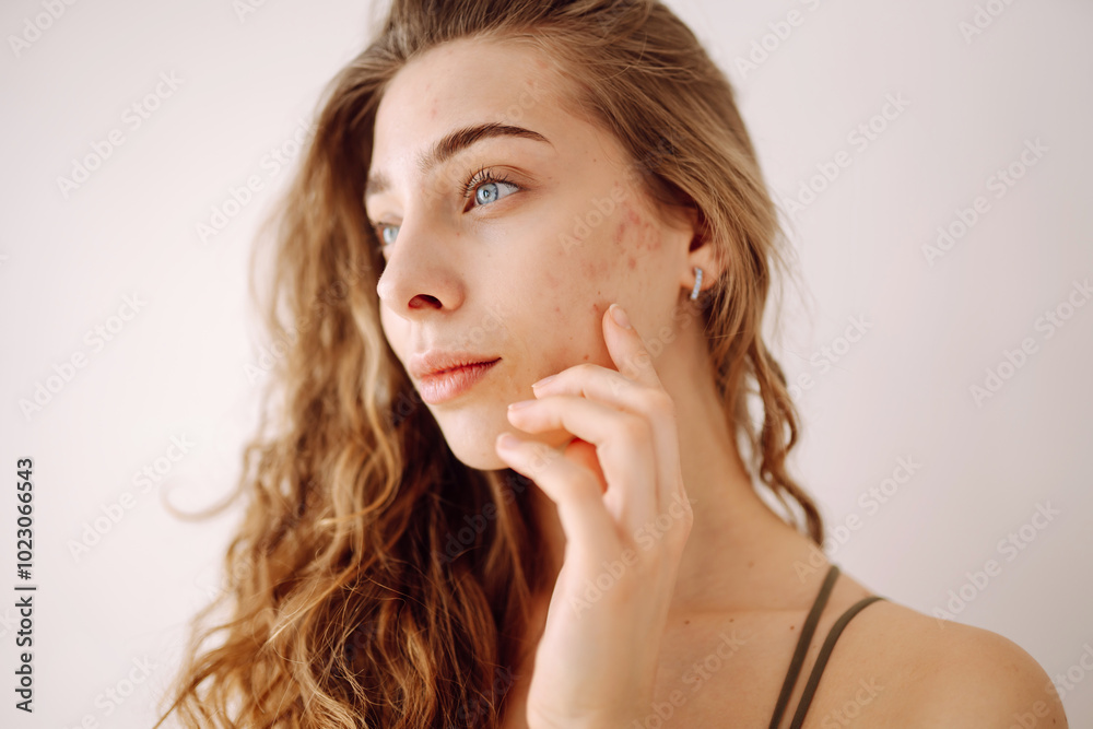 Young woman with acne and rashes on her face. Dermatology, cosmetology, skin care. Natural skin. Young woman with acne and rashes on her face. Dermatology, cosmetology, skin care. Natural skin.