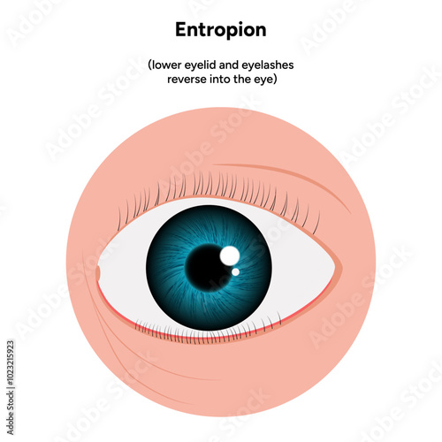 Entropion eye ophthalmology problem