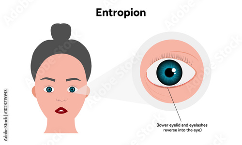 Entropion eye ophthalmology problem
