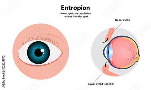 Entropion eye ophthalmology problem diagram and infographic 