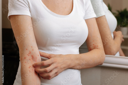 Itching and scabies in skin diseases that worsen the quality of human life. The girl combs the skin on her hand. Dermatitis, allergy, eczema, psoriasis concept. photo