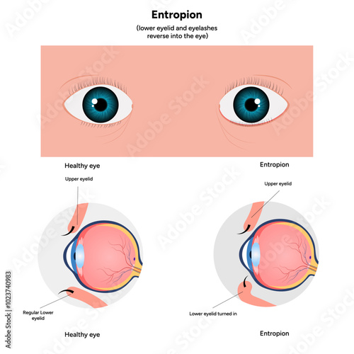 Entropion and healthy eye ophthalmology problem diagram and infographic 