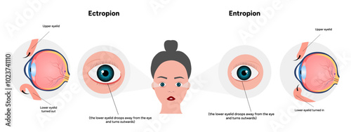 Entropion and ectopion ophthalmology eye problem infographic 
