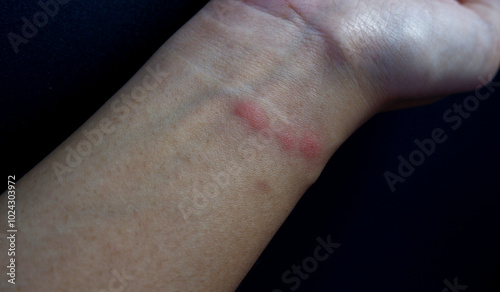 Fotografi Ant bites on the wrist with a black background