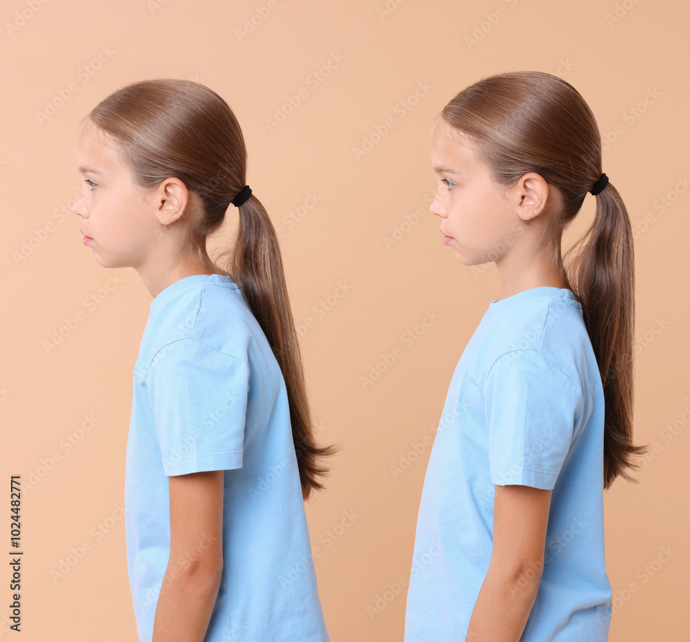 Good and bad posture, collage. Girl standing on dark beige background, side view