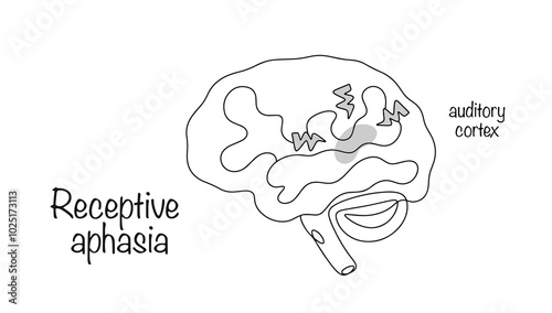Receptive aphasia