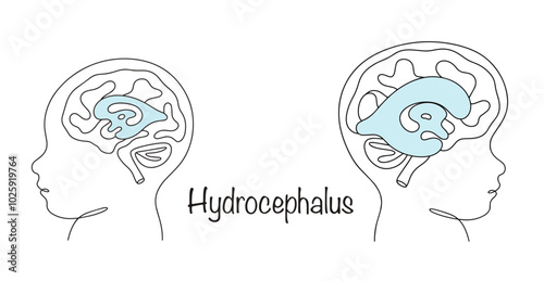 Hydrocephalus