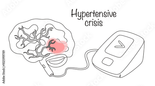 Hypertensive crisis